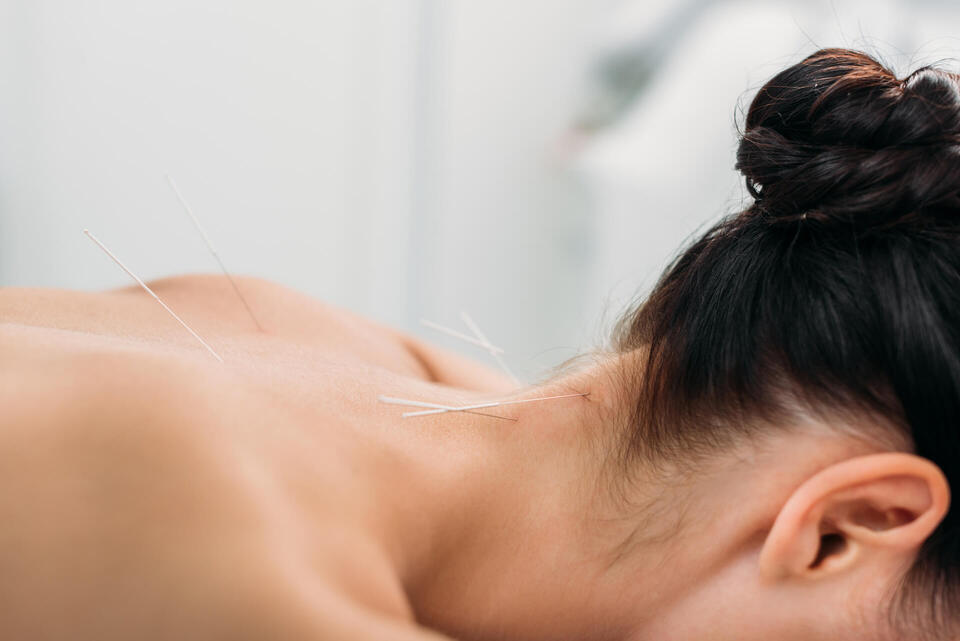 accupuncture